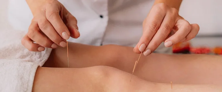 Acupuncture for Stress and Anxiety: Your Comprehensive Guide