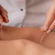 Acupuncture for Stress and Anxiety: Your Comprehensive Guide