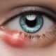 Home Remedies for Quick Relief from Eye Styes