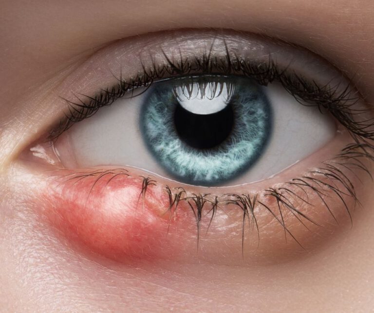 Eye Styes: Causes Explained and Effective Home Remedies
